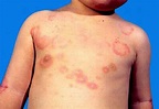 Erythema marginatum causes, symptoms, diagnosis & treatment