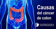 GASTROCLINICA | Causas del cáncer de colon