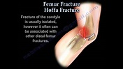 Hoffa Fracture - Everything You Need To Know - Dr. Nabil Ebraheim - YouTube