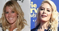 Heidi Montag's Plastic Surgery: A Look at Her Before and After Photos