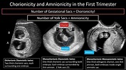 US Evaluation of Twin Pregnancies – Radiology.World