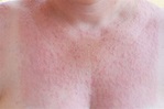 Sun Allergy: Rash Symptoms, Diseases, Skin Protection