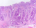 Adenocarcinoma Colon Histology