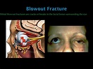 PPT - Fracture Types PowerPoint Presentation, free download - ID:2339788