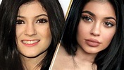 Kylie Jenner Before And After Plastic Surgery Photos