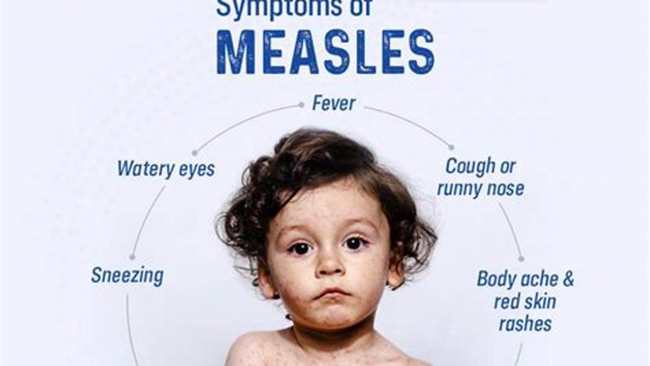 About 30% Of Children Have Measles Symptoms And About 25% End Up Hospitalized., 2024