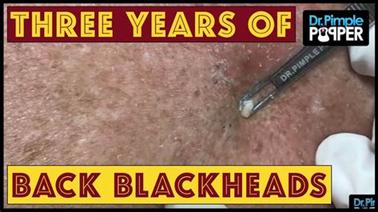 Back Blackheads 2024