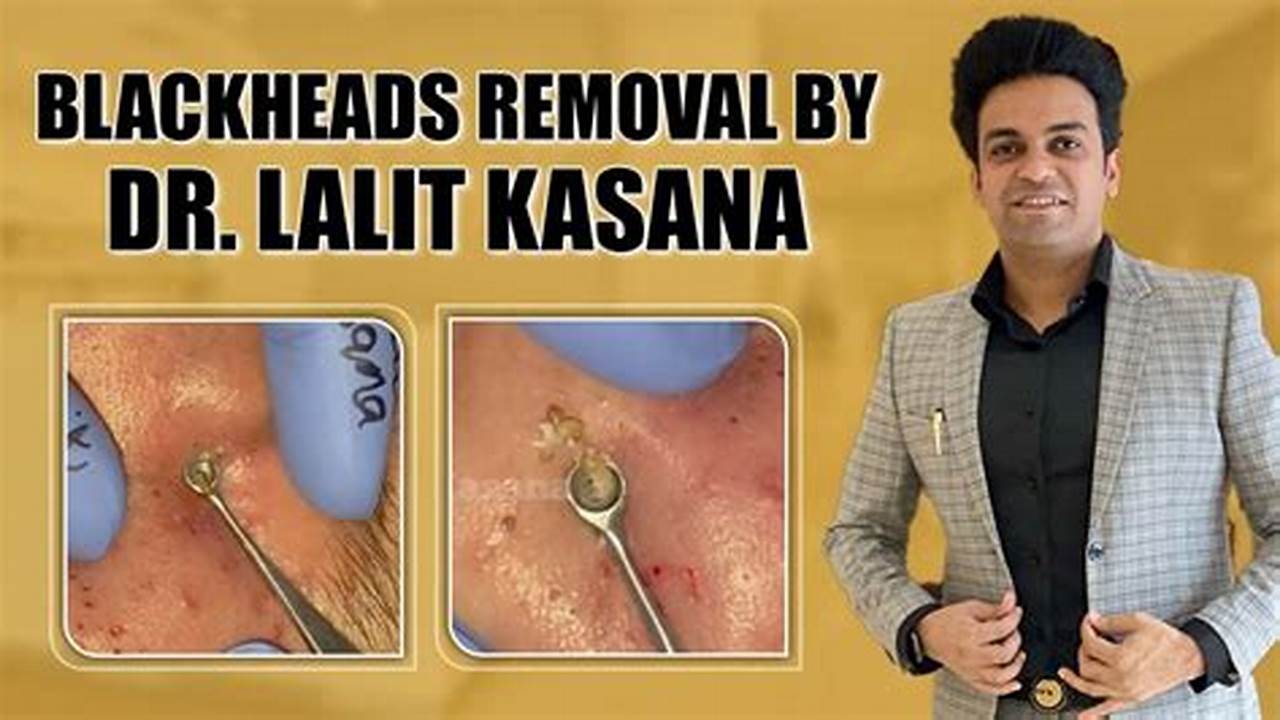 Big Deep Blackheads Removal Ii By Dr.lalit Kasana Ii Blackheads Removal, Blackheads + Bacne = A Popper Fanatic&#039;s Dream., 2024