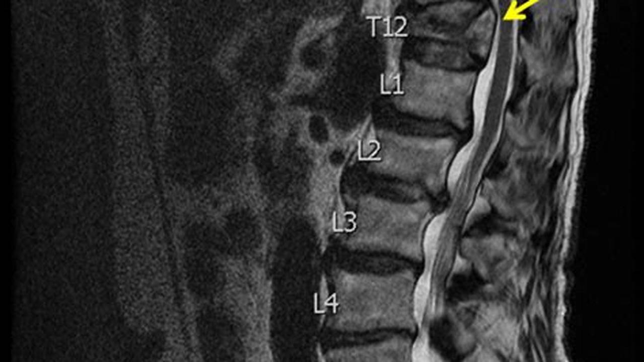 th?q=Compression%20Fractures%20Of%20The%20Spine%20Usually%20Occur%20At%20The%20Bottom%20Part%20Of%20The%20Thoracic%20Spine%20%28T11%20And%20T12%29%20And%20The%20First%20Vertebra%20Of%20The%20Lumbar%20Spine%20%28L1%29 Icd 10 For Compression Fracture