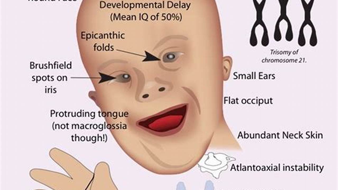 Down Syndrome, Like Any Other Genetic Variation, Contributes To., 2024