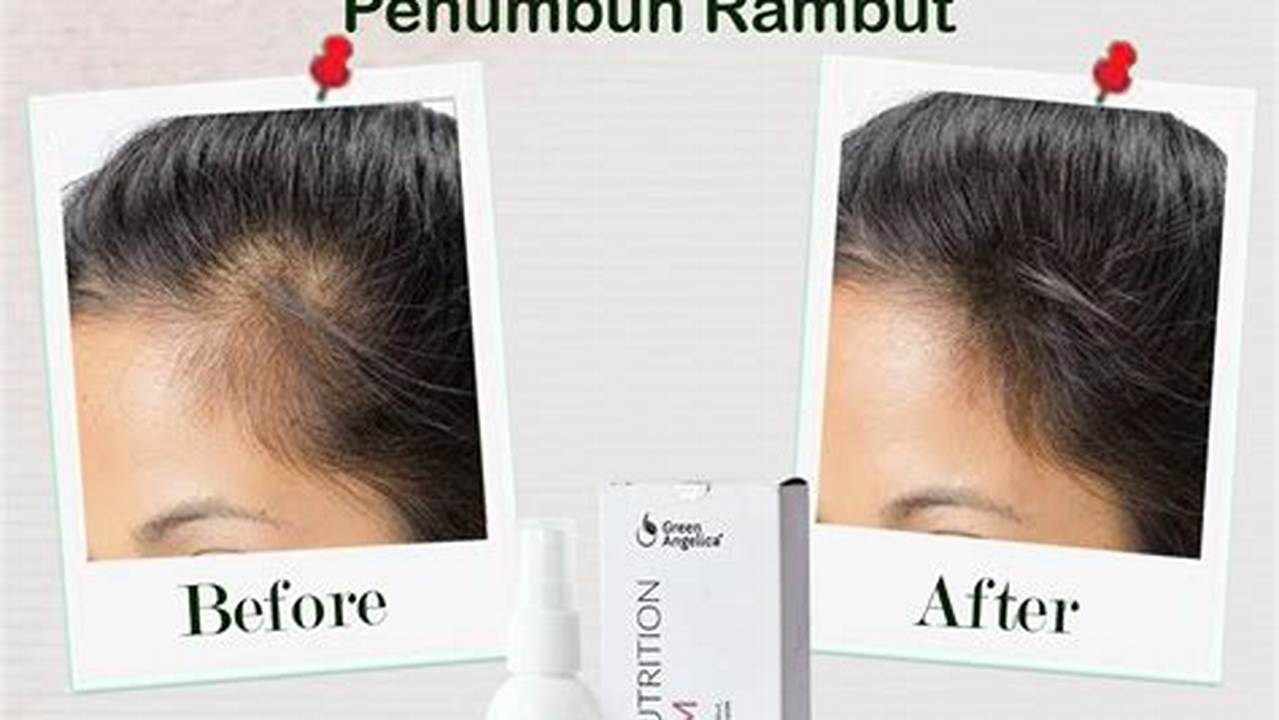 Efek Samping Vitamin Rambut, Penumbuh Rambut