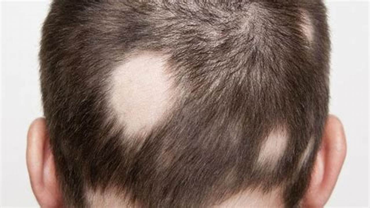 Genetika, Penyakit Rambut