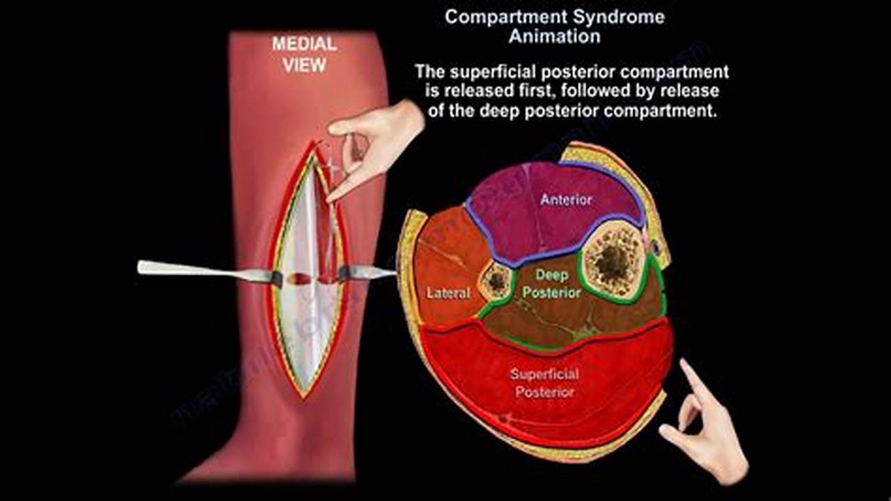 Is Compartment Syndrome Genetic