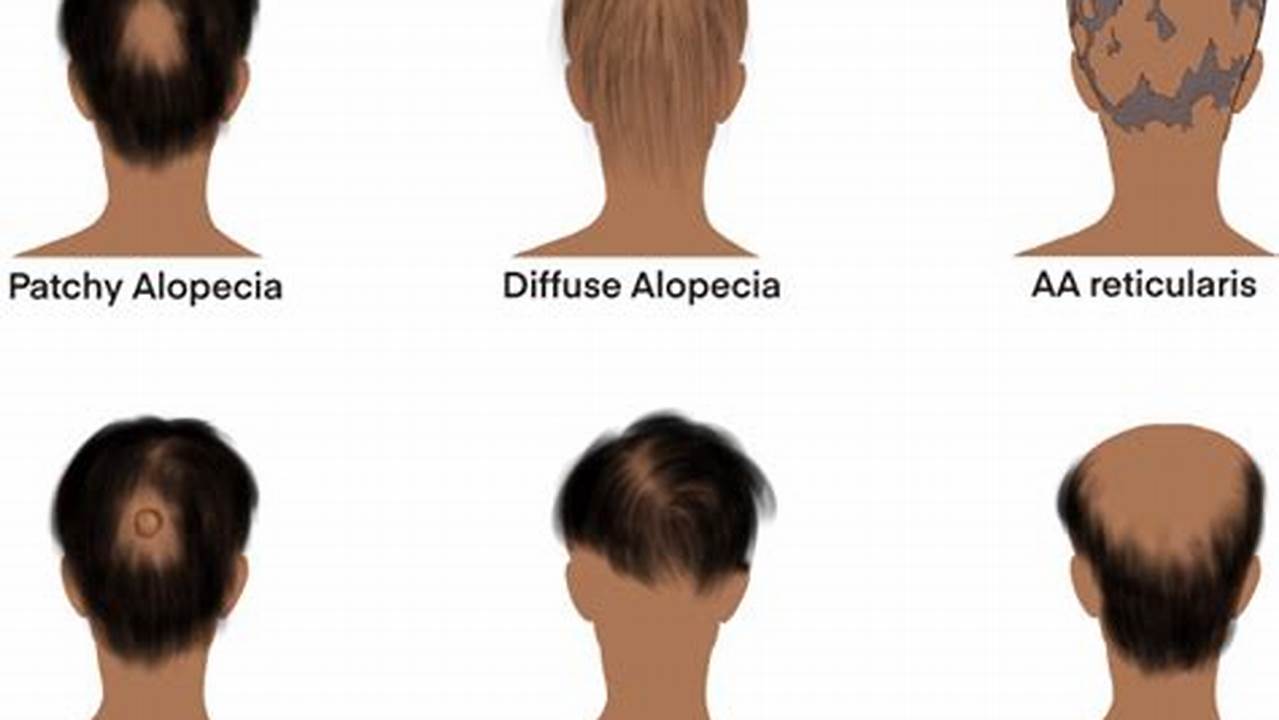 Jenis-jenis Alopesia, Penyakit Rambut