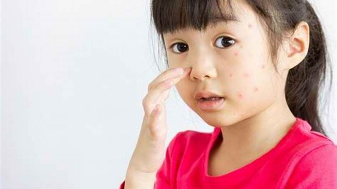 Alergi Anak: Gejala Penting yang Patut Diketahui