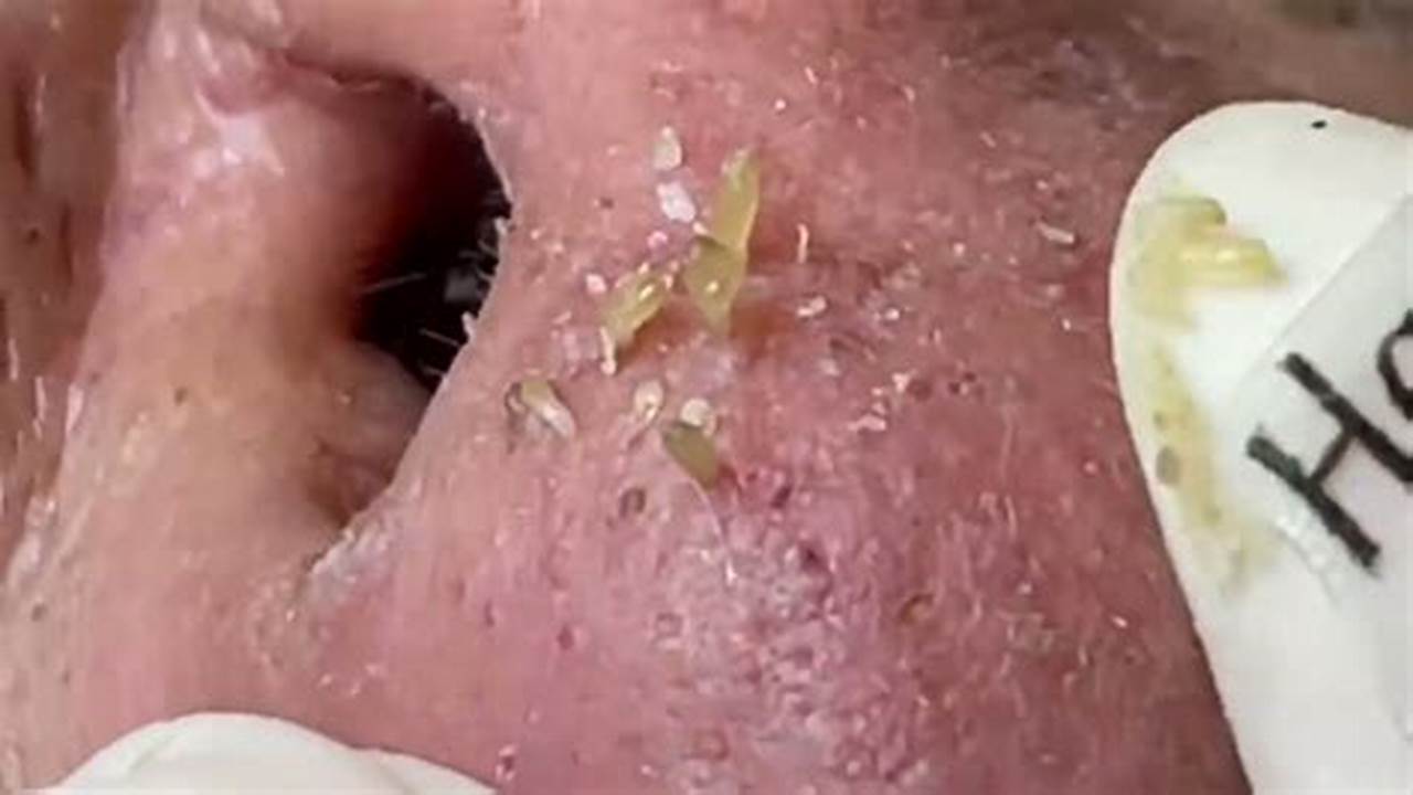 Newest Blackhead Removal Videos July 2024 Youtube., 2024