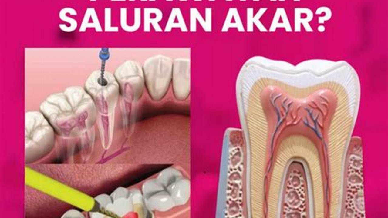 Perawatan Saluran Akar, Tips Kesehatan