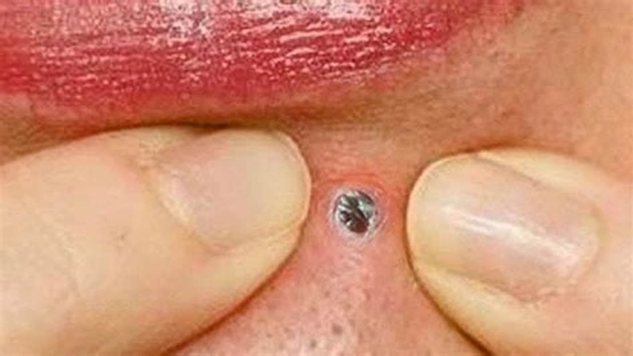 Pimple Popping Videos 2024 Blackheads Popping