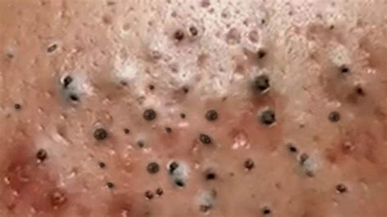 Pimple Popping Videos New Youtube 2024 New Videos March