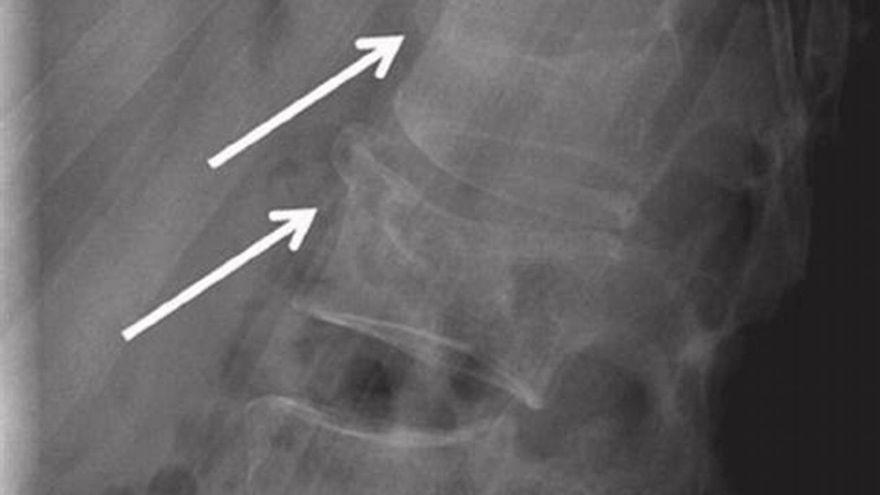 th?q=Wedge%20Compression%20Fracture%20Of%20First%20Lumbar%20Vertebra Icd 10 For Compression Fracture