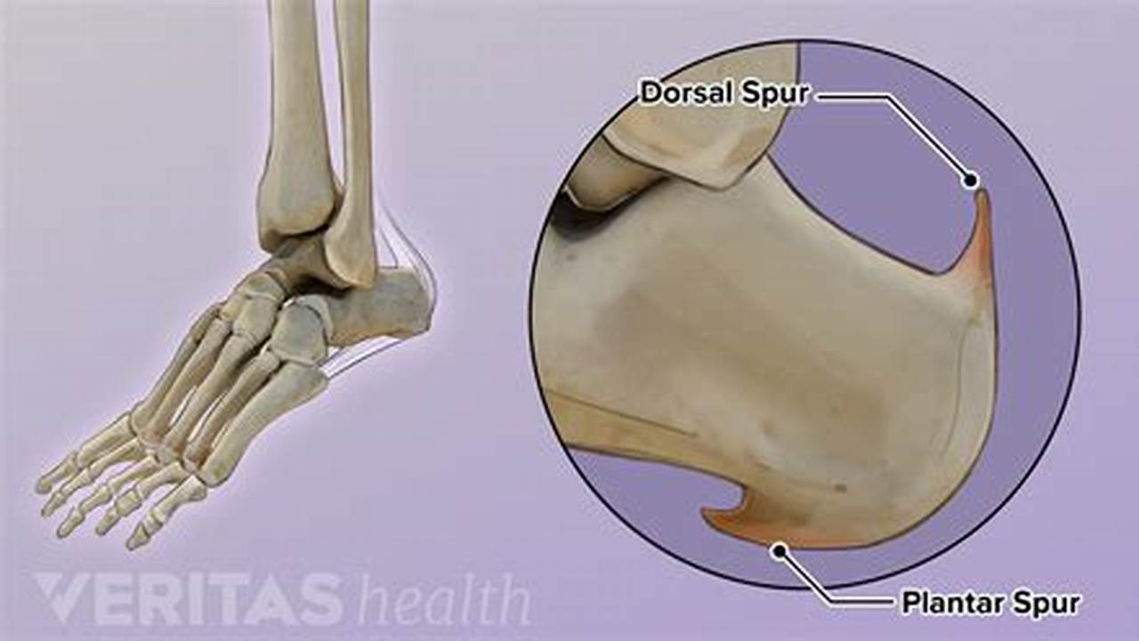 Bone Spur Under Achilles