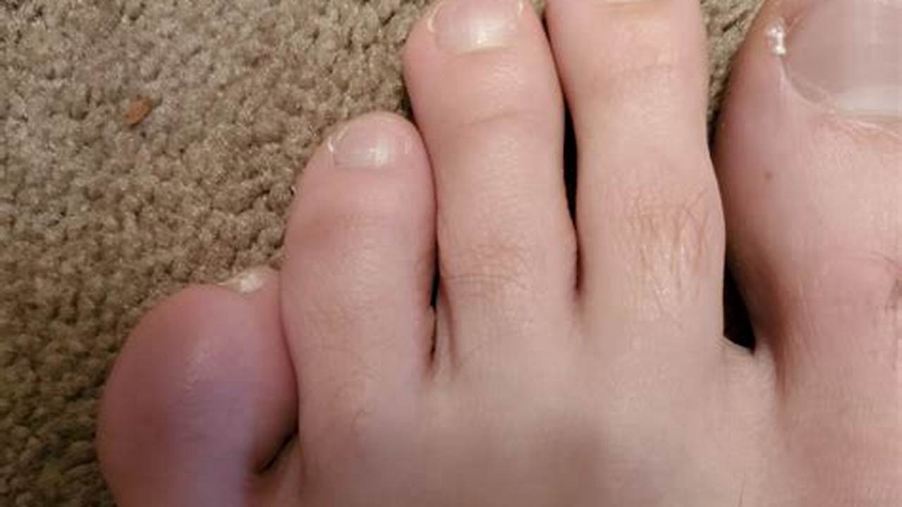 Bursitis Pinky Toe