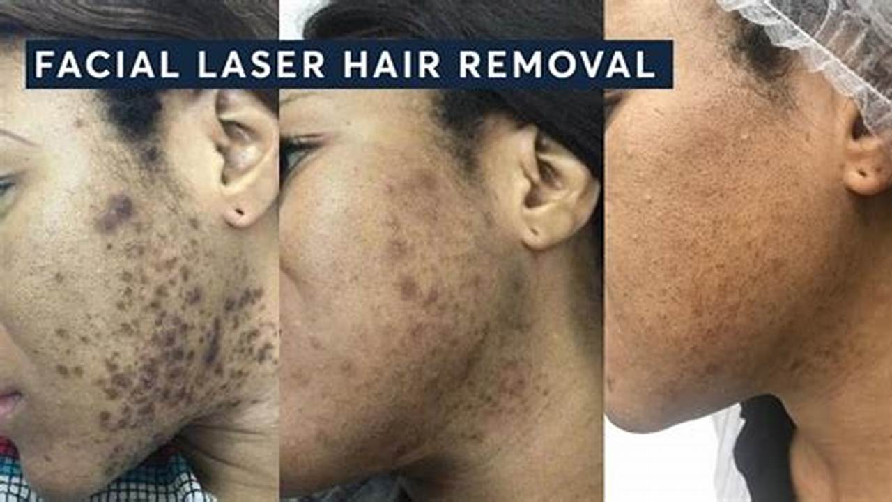 Discover Truths: Can Laser Hair Removal Lead to Ingrown Hairs?