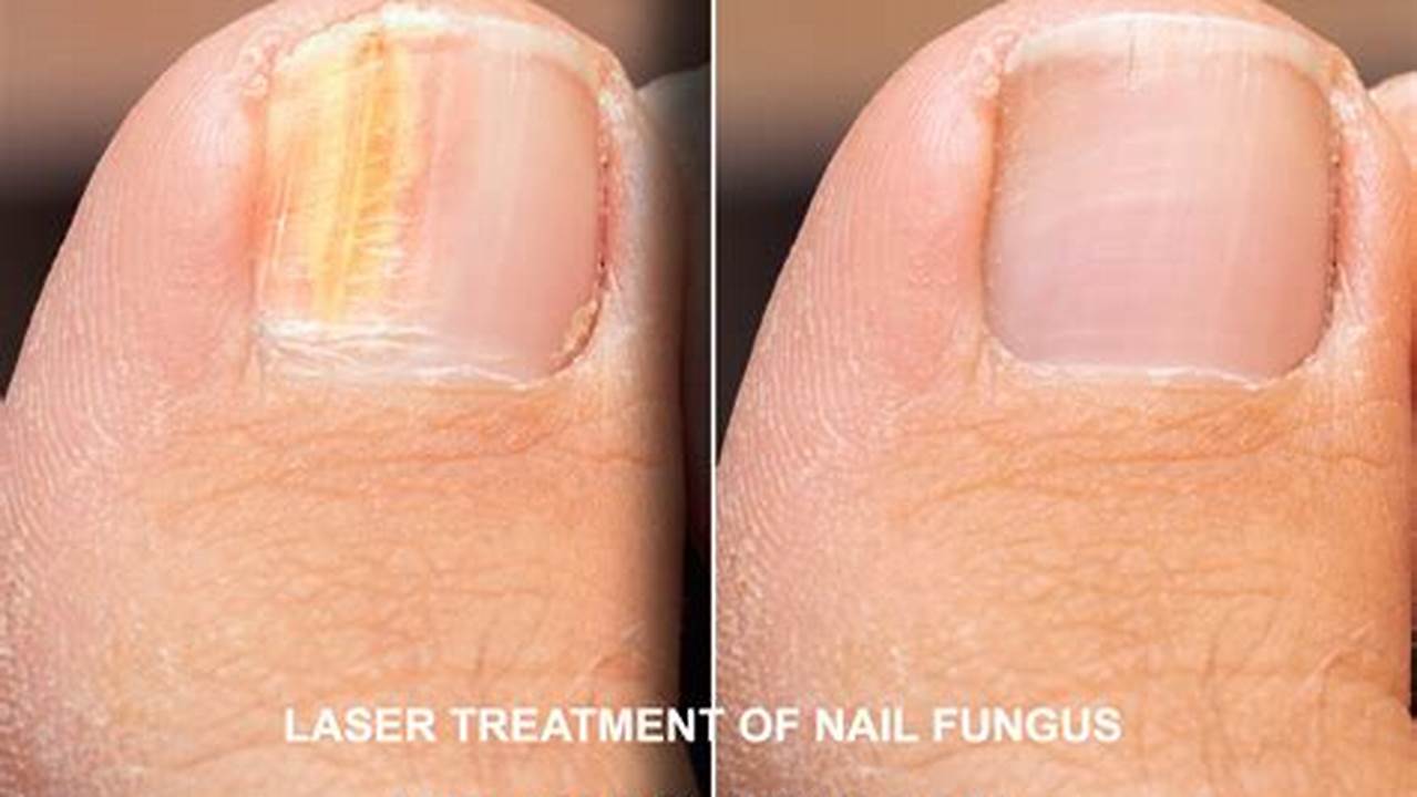 Cost of Laser Nail Fungus Treatment