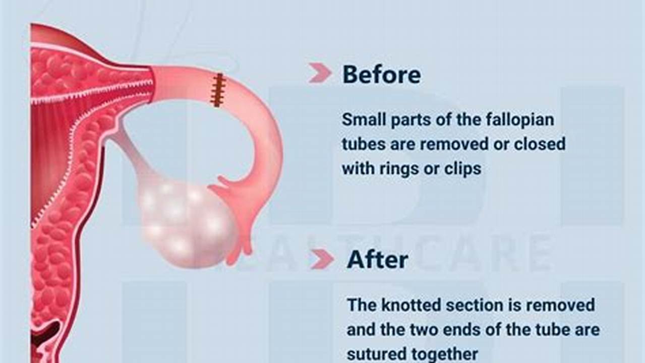 How Long After Tubal Ligation Can Tubes Grow Back