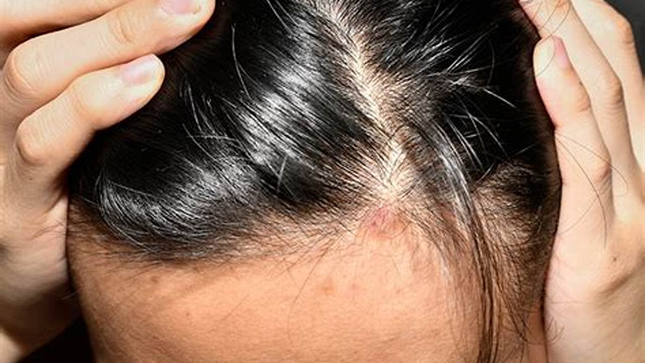 Gejala Kepala Pusing dan Rambut Rontok: Tanda Penyakit Apa?