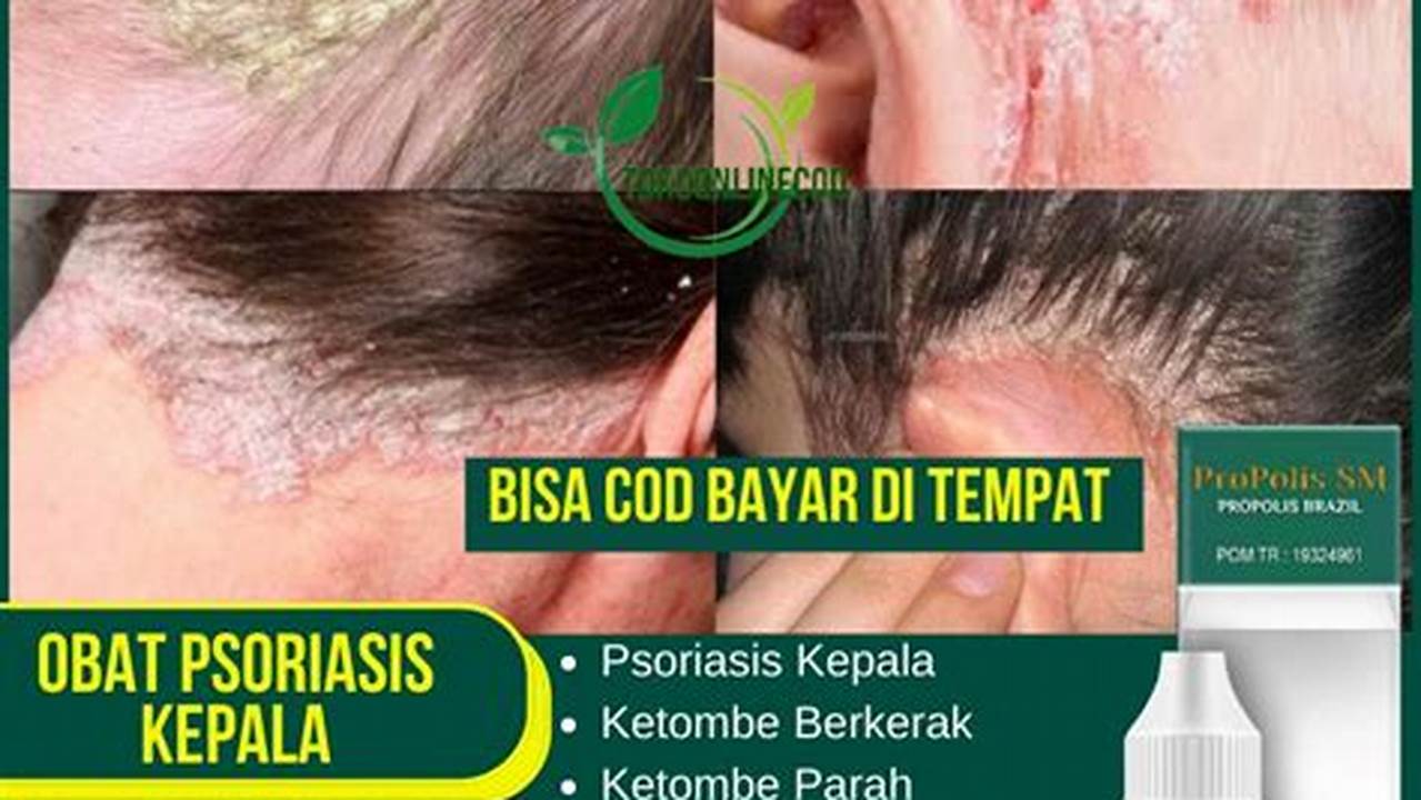 Penemuan dan Wawasan Terobosan tentang Obat Psoriasis yang Akan Mengubah Segalanya