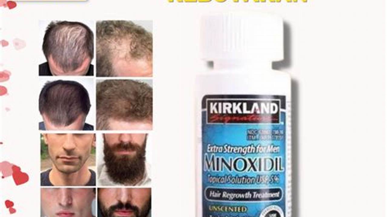 Rahasia Rambut Lebat dengan Obat Ajaib Minoxidil!