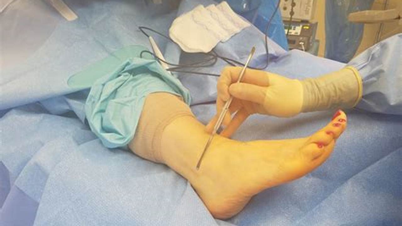 Peroneal Tendon Surgery: Patient Experiences and Outcomes