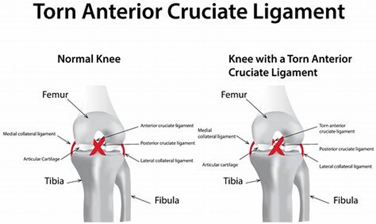 Acl Injuries Nfl 2024