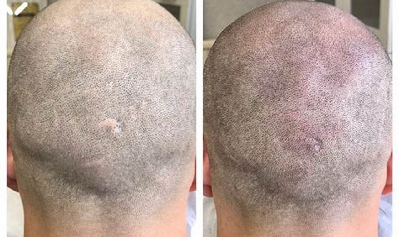 Alopecia New Treatment 2024