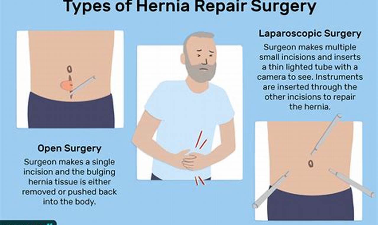 Hernia Repair Cpt Code 2024