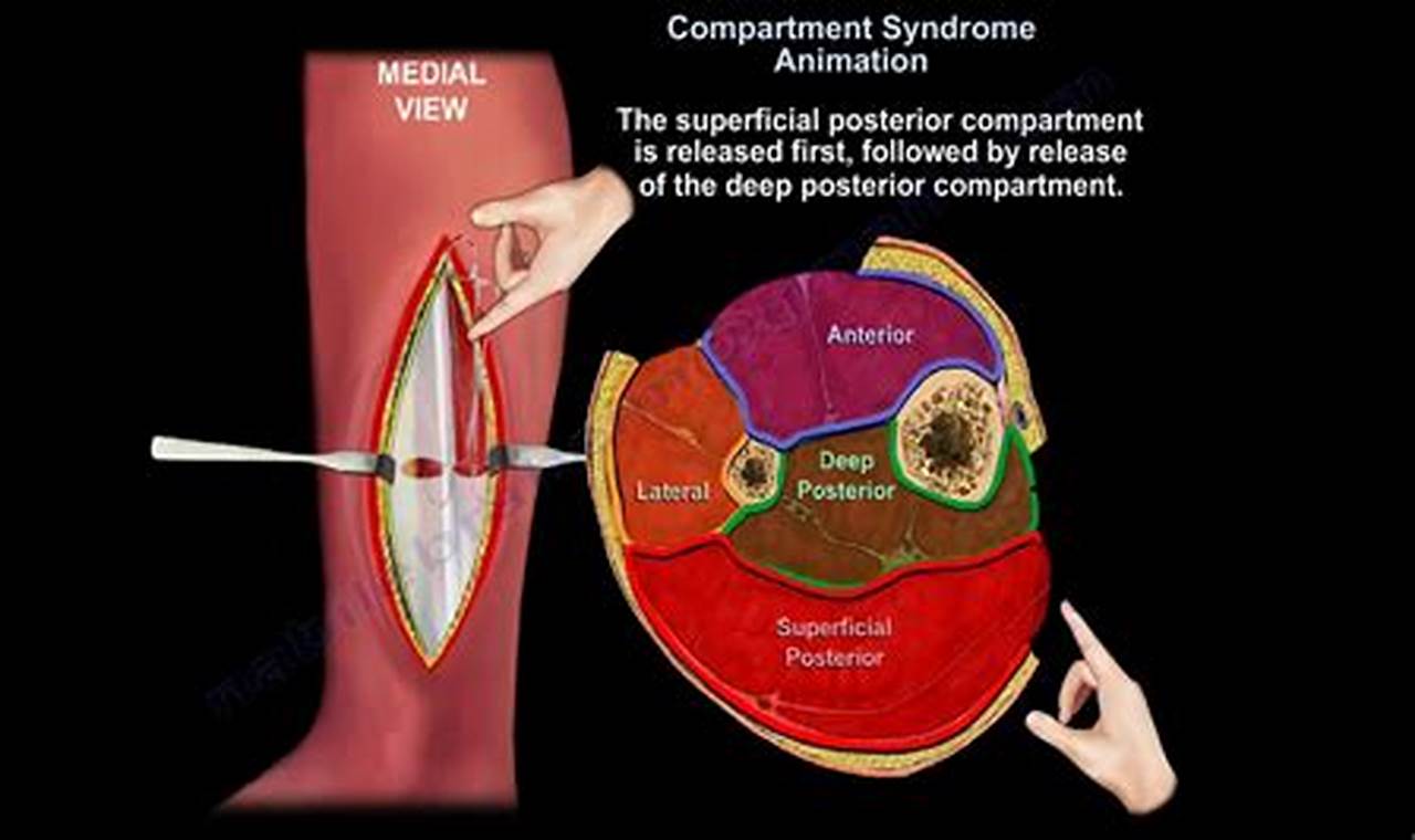 Is Compartment Syndrome Genetic