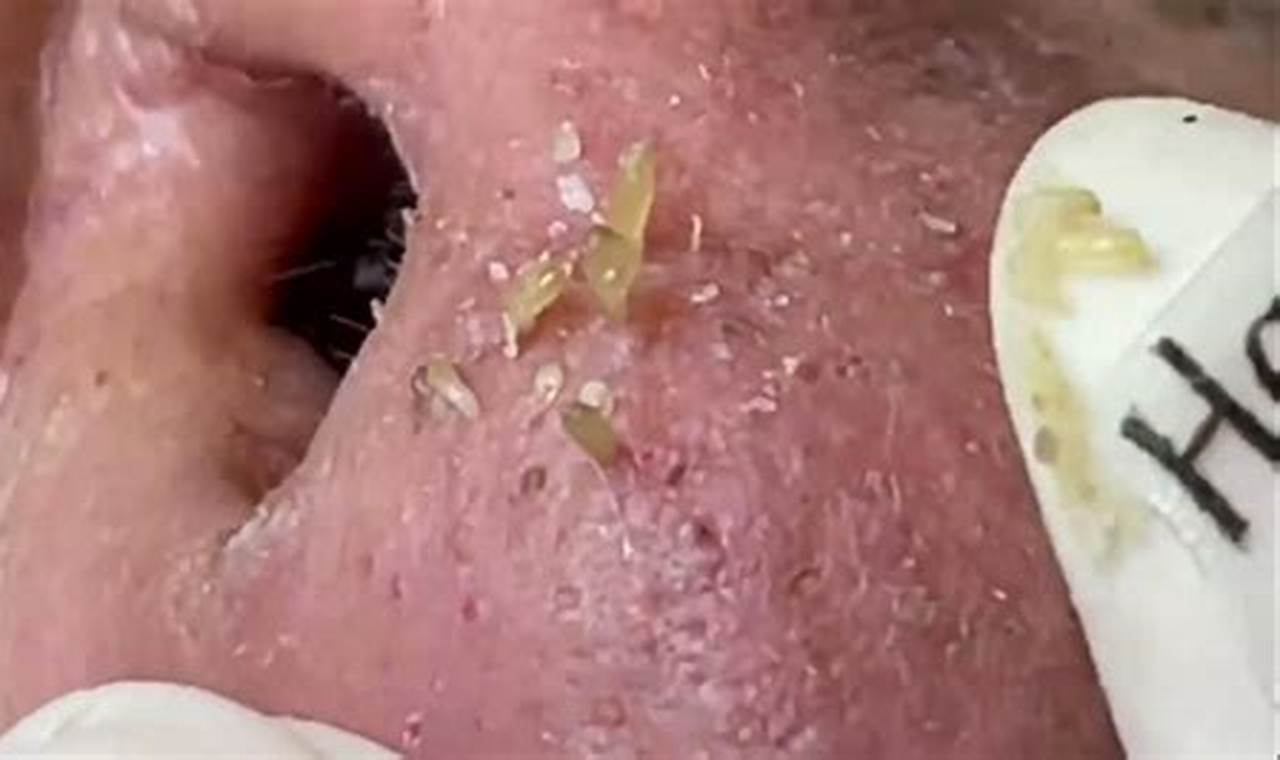 New Blackhead Removal July 11 2024 Youtube