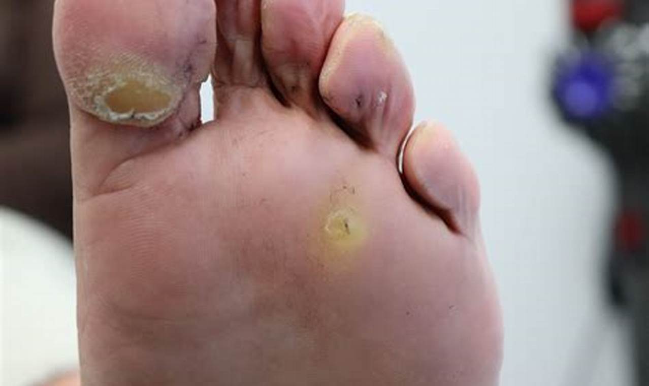 Plantar Wart Or Corn Pictures