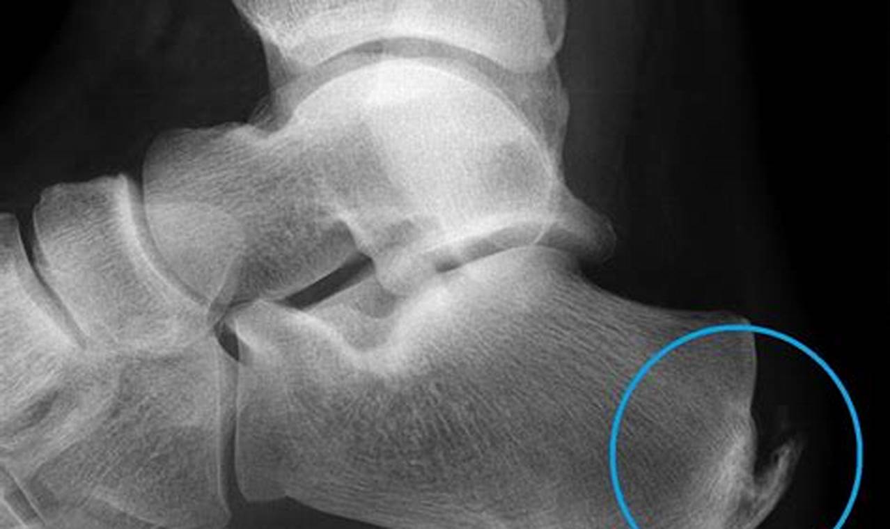 Achilles Tendon Bone Spur Treatment