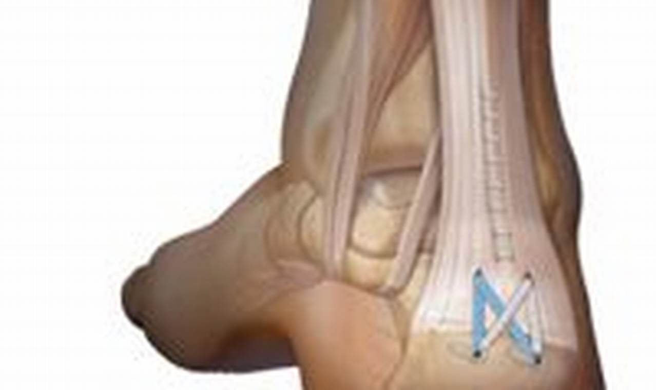 Achilles Tendon Debridement and Removal of Bone Spur: Recovery Time
