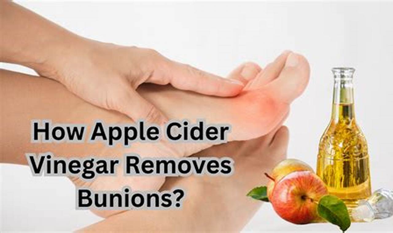 Apple Cider Vinegar Removes Bunions