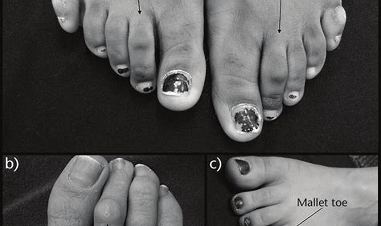 Are Hammer Toes Genetic?