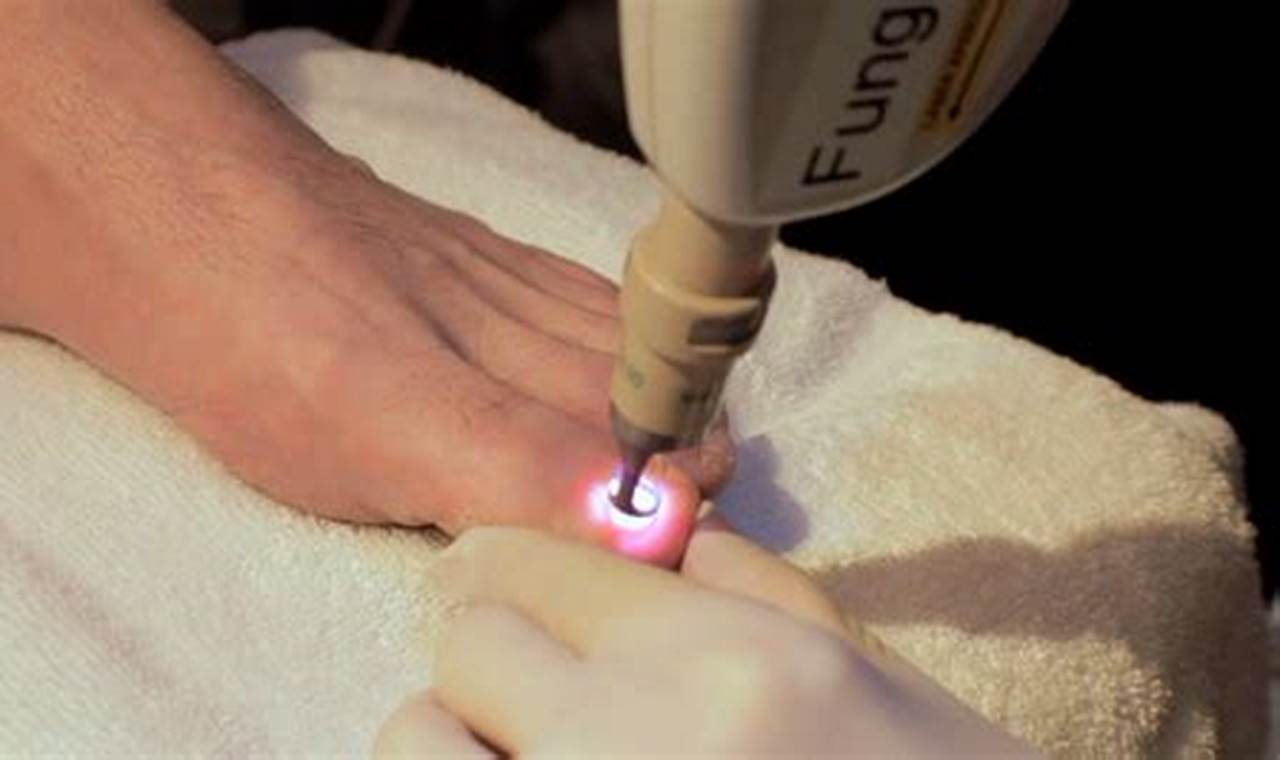 At Home Laser For Toenail Fungus