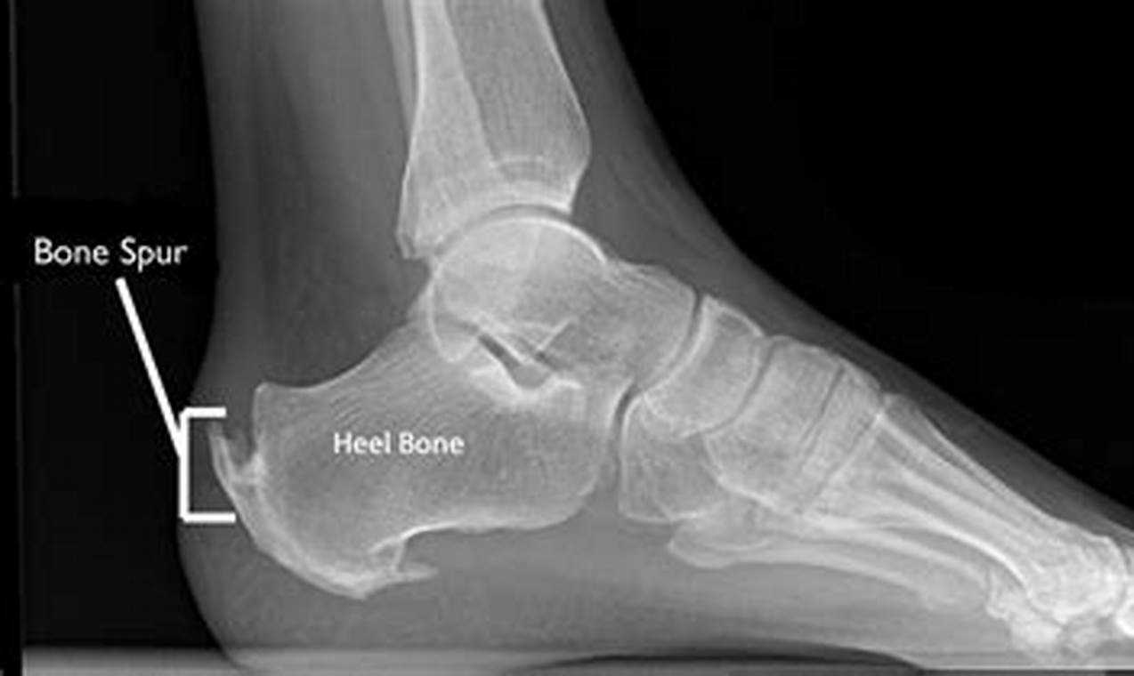 Bone Spur on Achilles