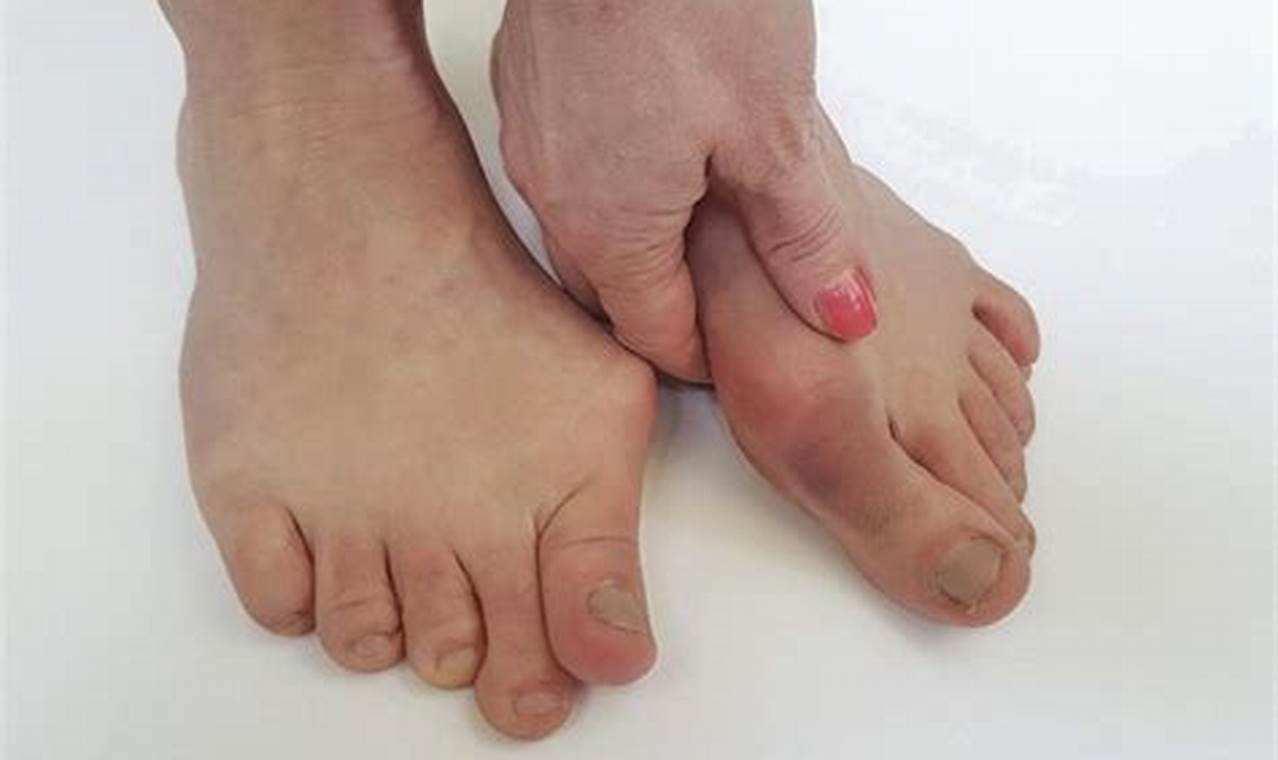 Bone Spur or Bunion: Causes, Symptoms, and Treatment