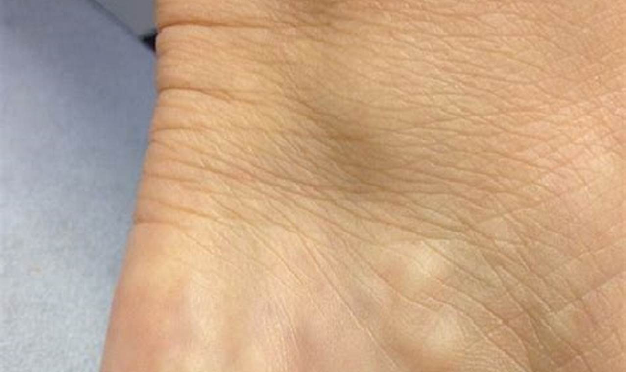Bumps on the Heel of the Foot