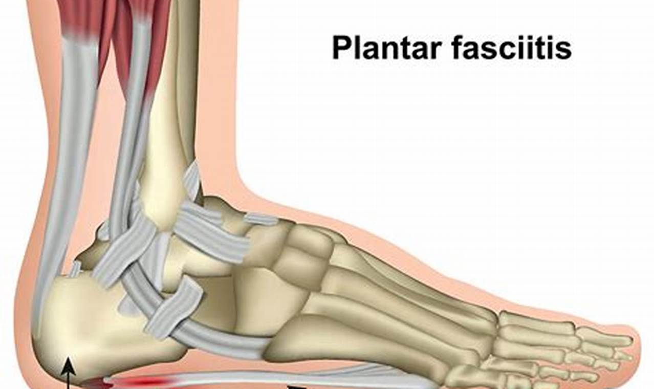 Can Plantar Fasciitis Cause Groin Pain?