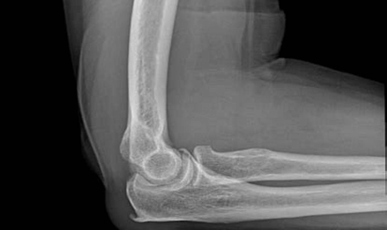 Elbow Bone Spur Images