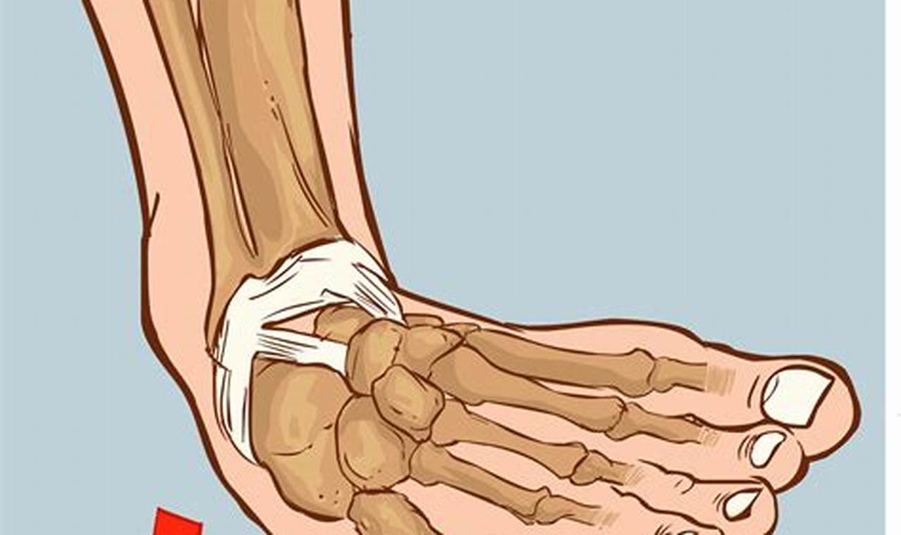 Heel Pain Sprained Ankle